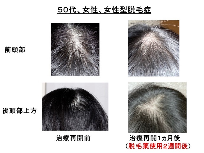 円形脱毛症　病院